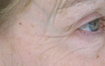 Close-up of a person's eye, showing wrinkles and aging skin.